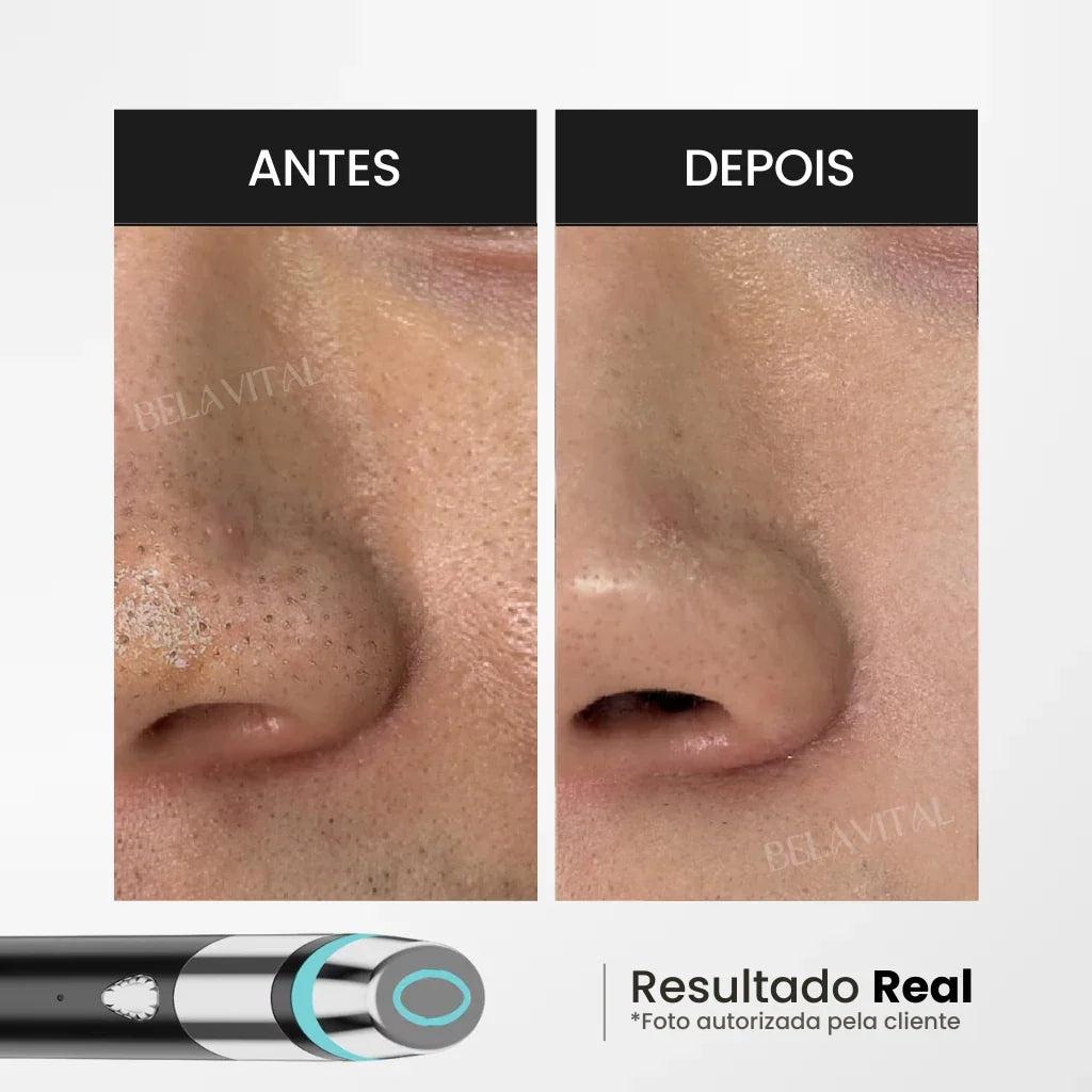 AGE Booster Pro: Dispositivo Coreano de Cuidado Facial